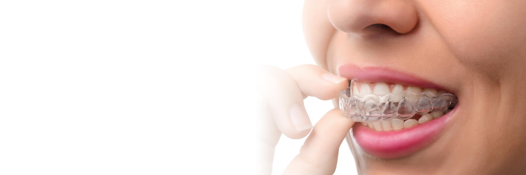 Invisalign and Traditional Orthodontics | Orthodontist